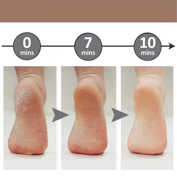 LIXA ELÉTRICA REMOVEDORA DE CALOS E RACHADURAS SKIN LINE