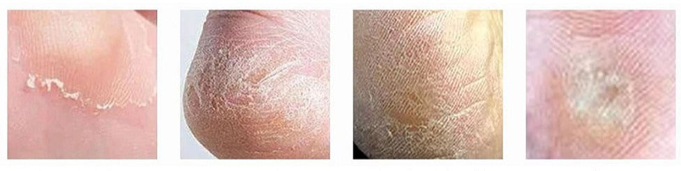 LIXA ELÉTRICA REMOVEDORA DE CALOS E RACHADURAS SKIN LINE